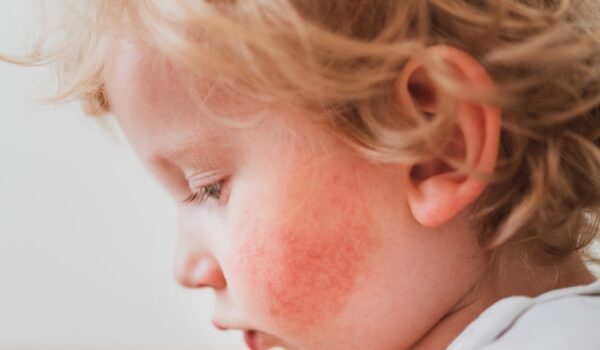 Bambini e adolescenti con dermatite atopica hanno un rischio più elevato di disturbi mentali