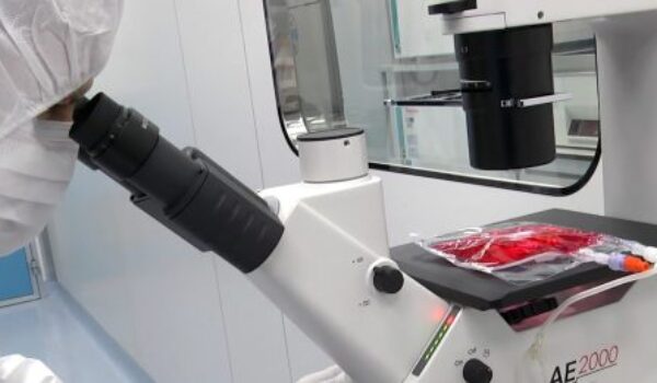 Terapia con cellule CAR T in malattie autoimmuni in adolescenti al Bambino Gesù