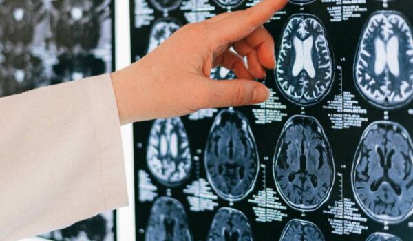 Tumori cerebrali pediatrici: i campanelli di allarme dalla nascita all’adolescenza