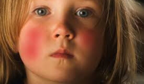 Impatto psico-sociale ed economico della dermatite atopica nei bambini e nell’età di transizione