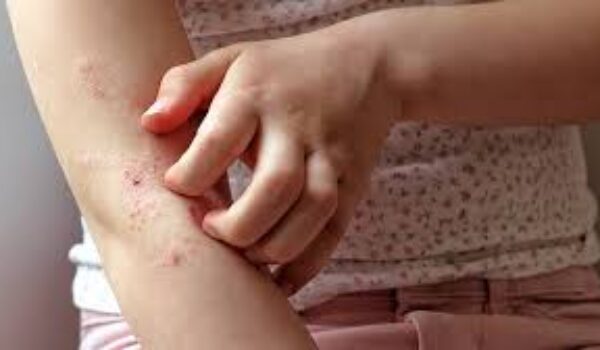 Dermatite atopica: non incide sullo sviluppo puberale