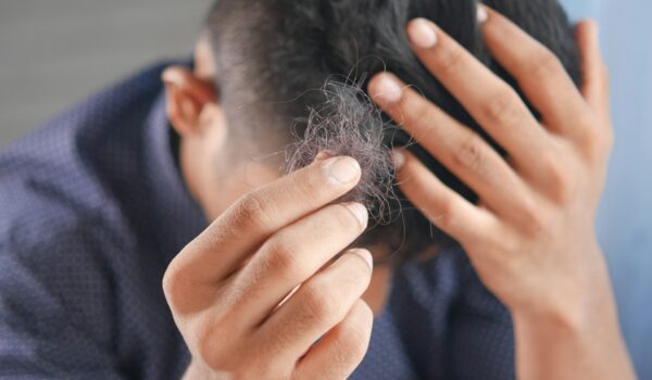 Alopecia, arriva la prima terapia orale anche per adolescenti