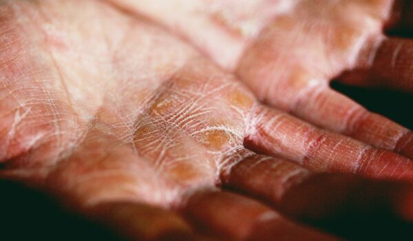 Dermatite Atopica nell’adolescenza